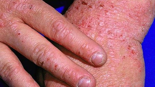 Eczema Common Skin Conditions