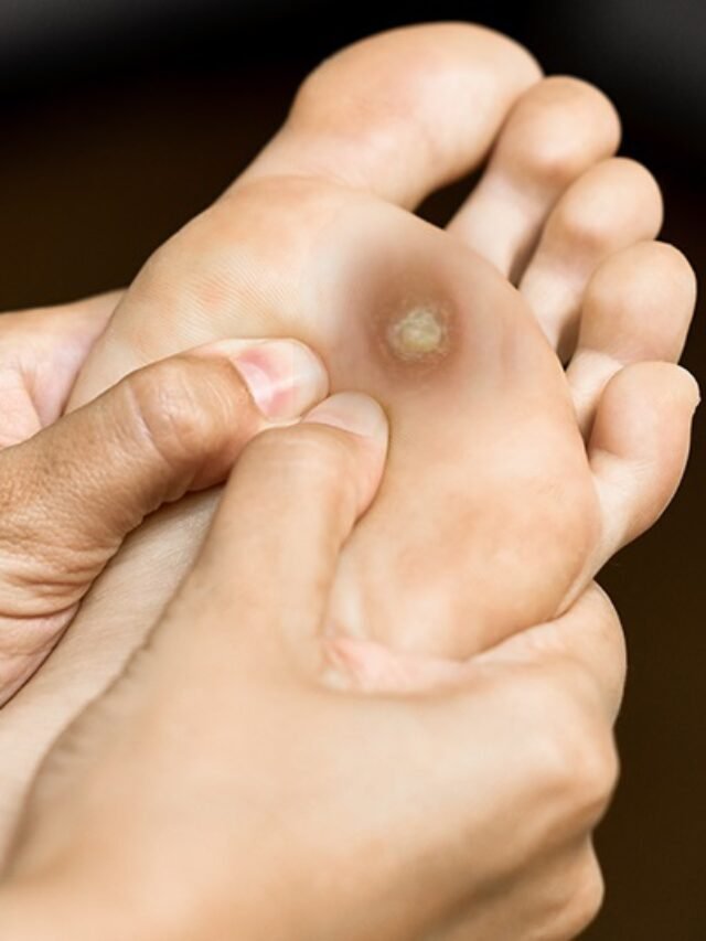 Home Remedies To Treat Your Corns And Calluses