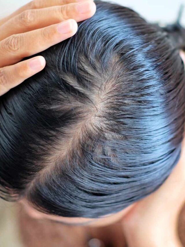 Natural Ways To Treat Greasy Scalp & Hair